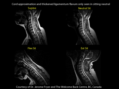 Upright MRI Findings