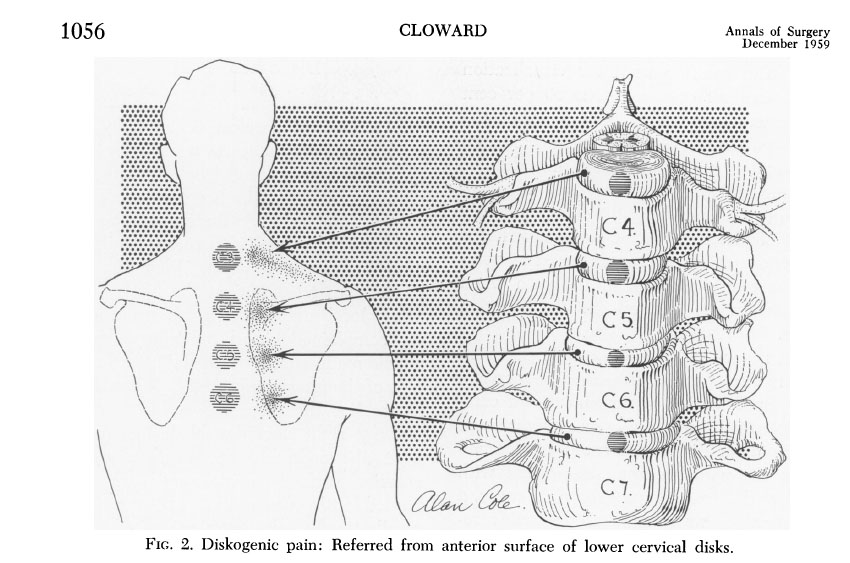  shoulder pain - spine diagram