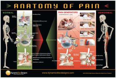 Tense Muscles and Disc Compression