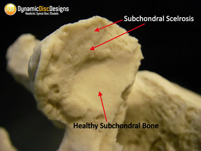Spinal Stenosis - 3