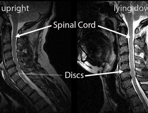 Spinal Cord Compression While Upright