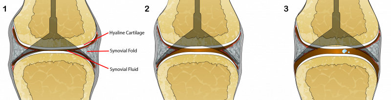 Milestone Udseende Elektriker What may be causing the cracking sound of a synovial joint